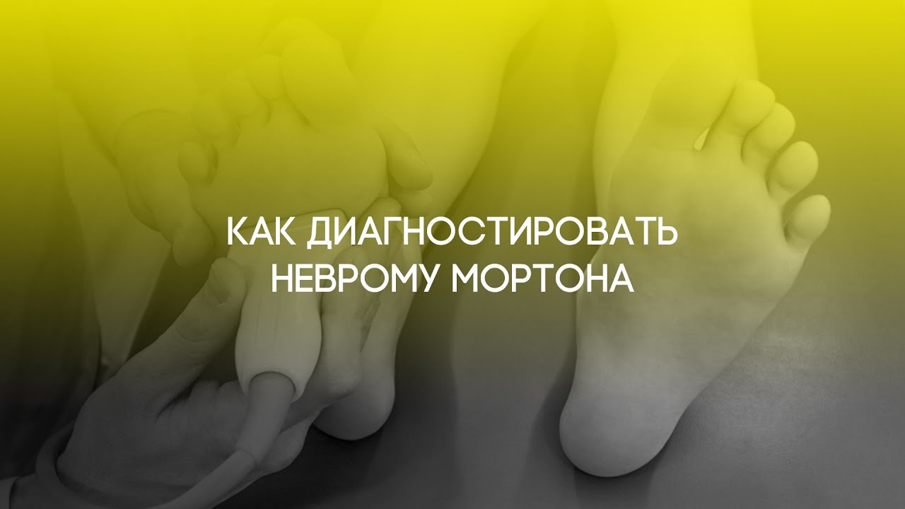 ❗️ ДИАГНОСТИКА НЕВРОМЫ МОРТОНА: УЗИ ИЛИ МРТ? ТРАВМАТОЛОГ-ОРТОПЕД ИГОРЬ ПАХОМОВ.