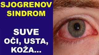 SJOGRENOV SINDROM - suve oči, usta, koža.../dr Bojana Mandić