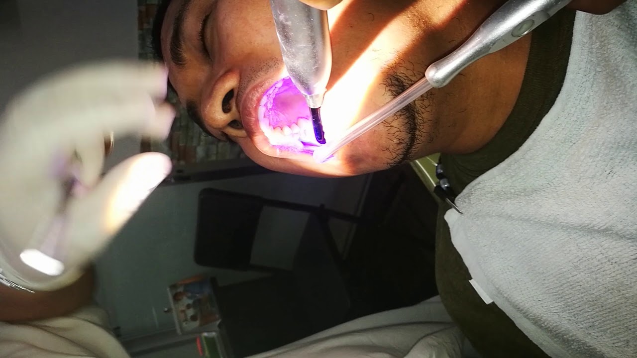 TEETH CLEANING YouTube