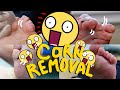 MOAR Corn removal Compilation with Callus and Nails!!