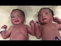 Newly Born Twin Babies For Ivf Couple At Dr PADMAJA FERTILITY Center(IVF & Surrogacy), Hyderabad