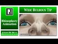 Rhinoplasty animation - How can a Large and Wide Bulbous Tip be made smaller?