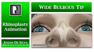 Rhinoplasty animation - How can a Large and Wide Bulbous Tip be made smaller?