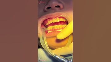 Chào đón nụ cười hoàn hảo cùng mắc cài buộc thun trong chỉnh nha!