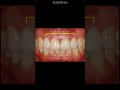 앞니 지르코니아 크라운 치료 Zirconia Crowns In Upper Anterior Teeth 앞니 지르코니아 크라운 치료 Zirconia Crowns In Upper Anterior Teeth