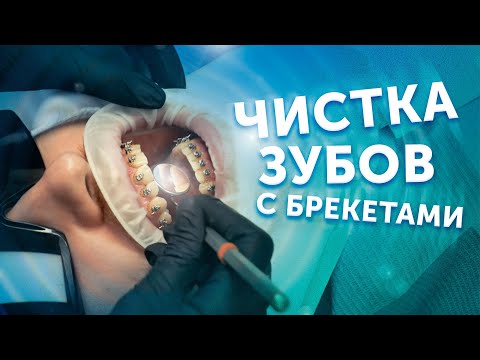 Чистка зубов с брекетами | Профессиональная гигиена