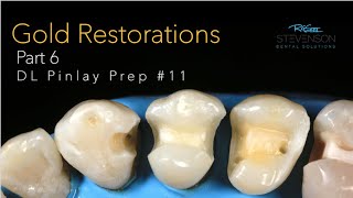 Cast Gold Restorations, Part 6: DL Pinlay Preparation