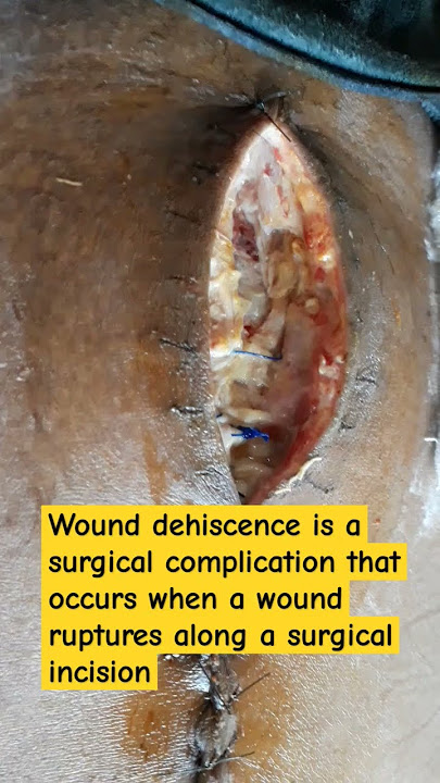 Wound Dehiscence in midline incision post emergency #Laparotomy #Surgery