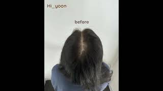 포항 하이윤 / 포항 smp / 포항 정수리 / 포항 정수리 탈모