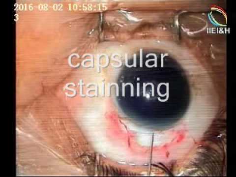 Steps Of Small Incision Cataract Surgery Dr Sohel Mahmud Youtube