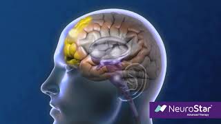 How Neurostar Work