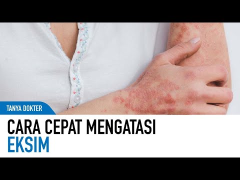 Video: 3 Cara Mengobati Eksim Tangan