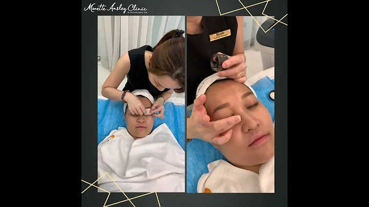 🔥TOP 3 最受歡迎激光【趕走黑眼圈】👉臨床證明能不單能淡化黑眼圈還能提升膚色 - 天天要聞