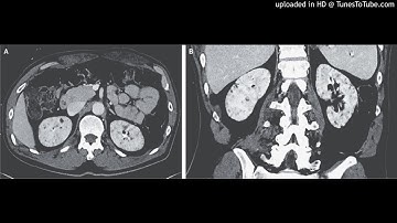 Lithium-Induced Nephropathy