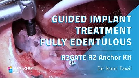 Guided Implant Treatment Fully Edentulous Patient Using R2 Anchor Kit by Dr. Isaac Tawil
