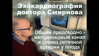 31. Общий Предсердно - Желудочковый Канал И Стеноз Легочной Артерии У Плода