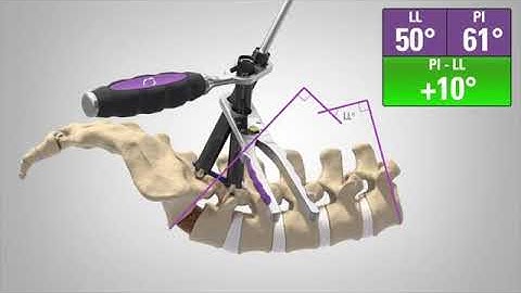 Nuvasive: MAS TLIF (Japan)