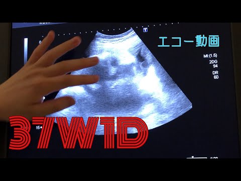 37週1日(37W1D) 妊娠10ヶ月 逆子の赤ちゃん 超音波エコー動画