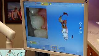 The CEREC Single-Visit Crown Process