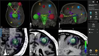 Elementsu2122 Multiple Brain Mets SRS