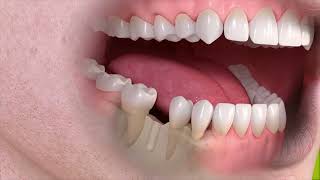 Dr. Jaron Theis Explains What Dental Implants Are!
