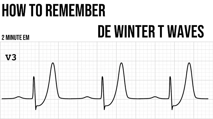 How to remember de Winter T waves