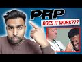 Does PRP Work For Male Pattern Baldness?