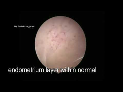 Translocation Iud Office Hysteroscopy IUD Translocation - YouTube