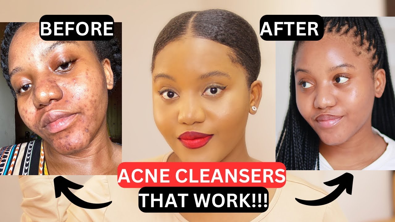 HOW I CLEARED MY ACNE WITH CLEANSERS (GUARANTEED RESULTS)!