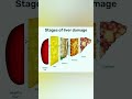 Stages of liver damage
