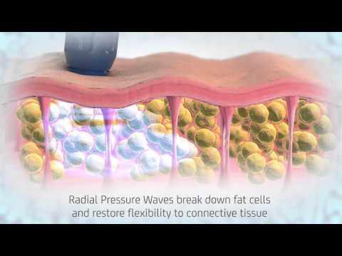 Chattanooga RPW Shockwave Therapy for Cellulite