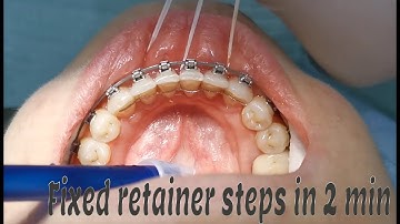Fixed #orthodontic retainer steps