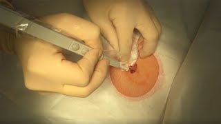 How to Properly Perform  Excision of a Lipoma by Nursing and NCLEX Mastery 723 views 1 year ago 11 minutes, 14 seconds