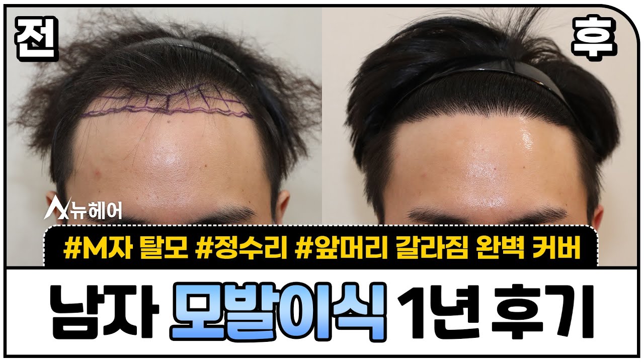 모발이식 후기! 1년 후 결과 보세요ㅣ1600모낭 ~ 2000모낭ㅣ뉴헤어