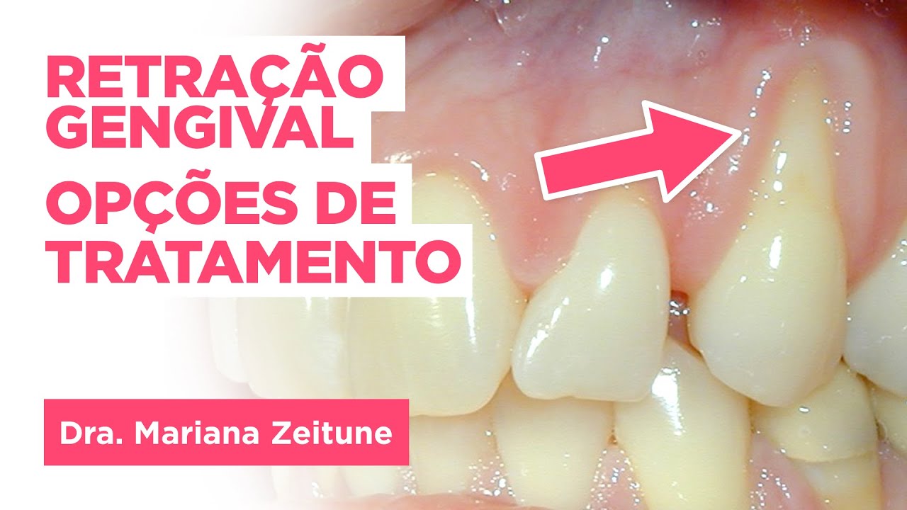 Gengiva Afastada Do Dente - RETOEDU