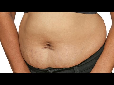 Image result for tummy after cs