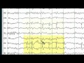 Focal EEG Abnormalities 1