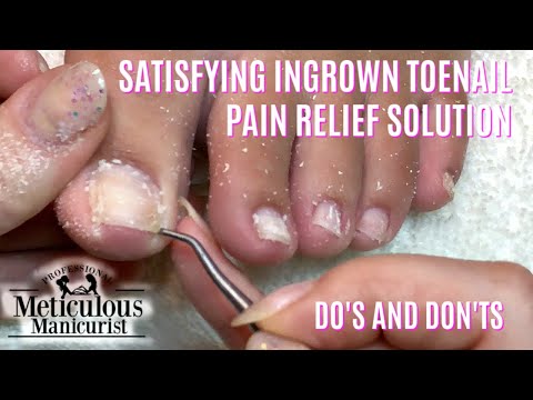 👣 राहत प्राप्त Toenrow Toenail दर्द Do & Don&rsquo;ts पेडीक्योर ट्यूटोरियल g