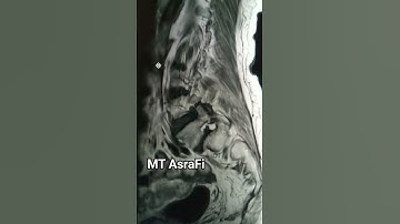 MRI Lumbar Spine #spine #mtasrafi #shorts