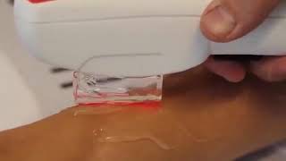 Hair Removal In Bikini Line, Underarm And Legs By Ellipse I2Pl Laser Youtube