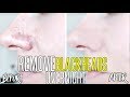 How To Get Rid Of Blackheads & Whiteheads OVERNIGHT !