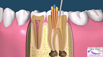 ¿Cuál es el porcentaje de éxito de una endodoncia?