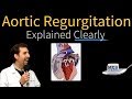 Aortic Regurgitation (Insufficiency) Explained Clearly