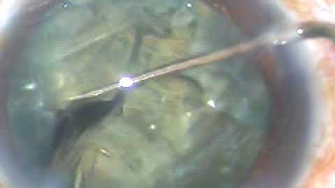 Phacoemulsification by "Divide and Conquer" Technique - P Mohanta