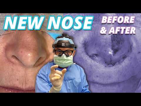 NEW NOSE: ALARPLASTY, OPEN TIP PLASTY, COLUMELLA REDUCTION