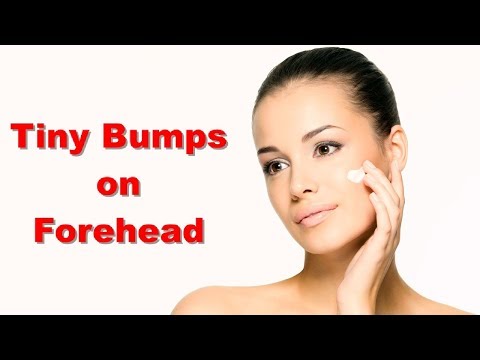 Tiny Bumps on Forehead Treatment How to Get Rid of Tiny Bumps on Forehead With Home Remedies