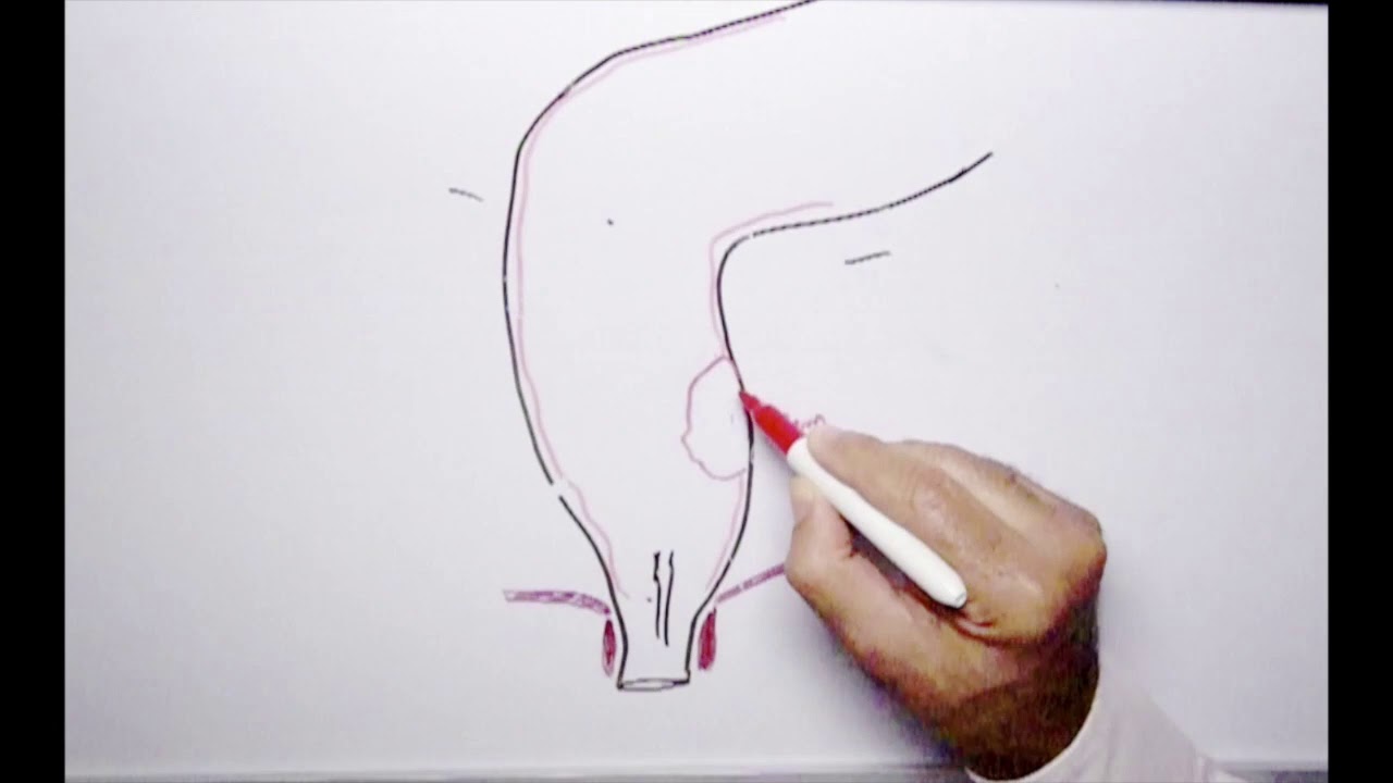 Operations for rectal cancer. عمليات اسئصال أورام المستقيم