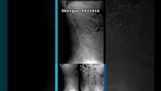 Shotgun Injury on X-Ray #shorts  #radiology #trauma