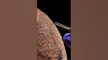 Quá trình cấy tóc