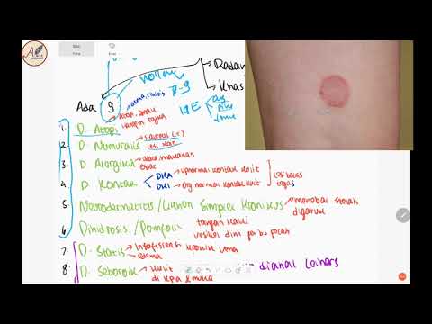 Video: Dermatitis Radiasi: Penyebab, Gejala, Dan 5 Metode Perawatan